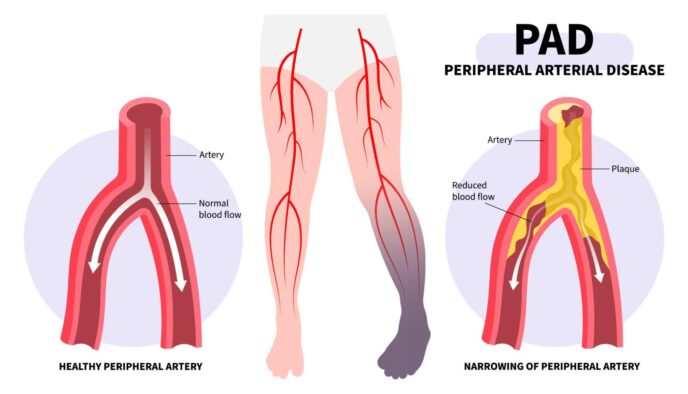What Is an Atherectomy? Procedure, Recovery & When You Need One