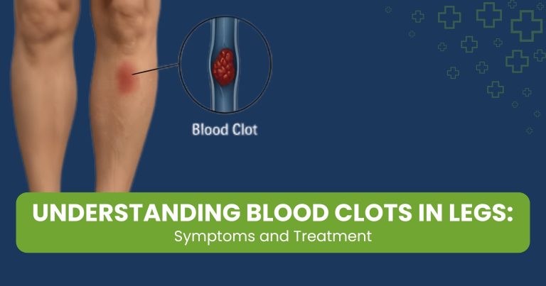 Understanding Blood Clots in Legs: Symptoms and Treatment Options