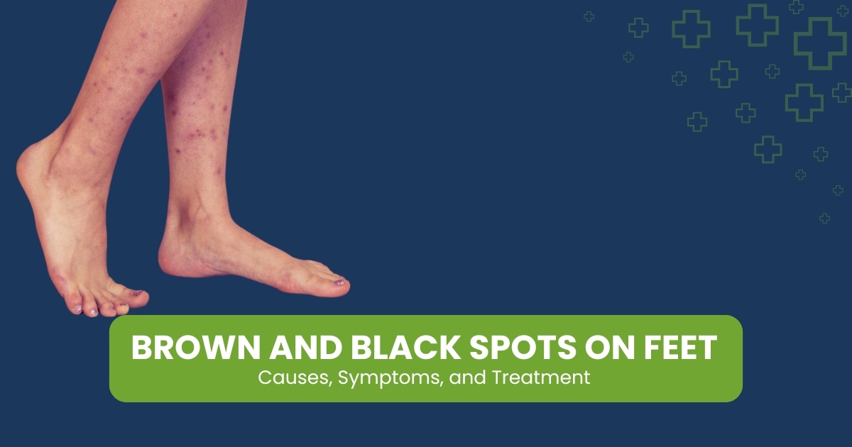 Brown and Black Spots on Feet: Causes, Symptoms & Treatment
