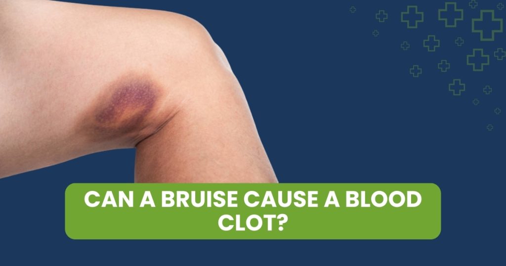 Bruise Cause a Blood Clot? Symptoms & Prevention