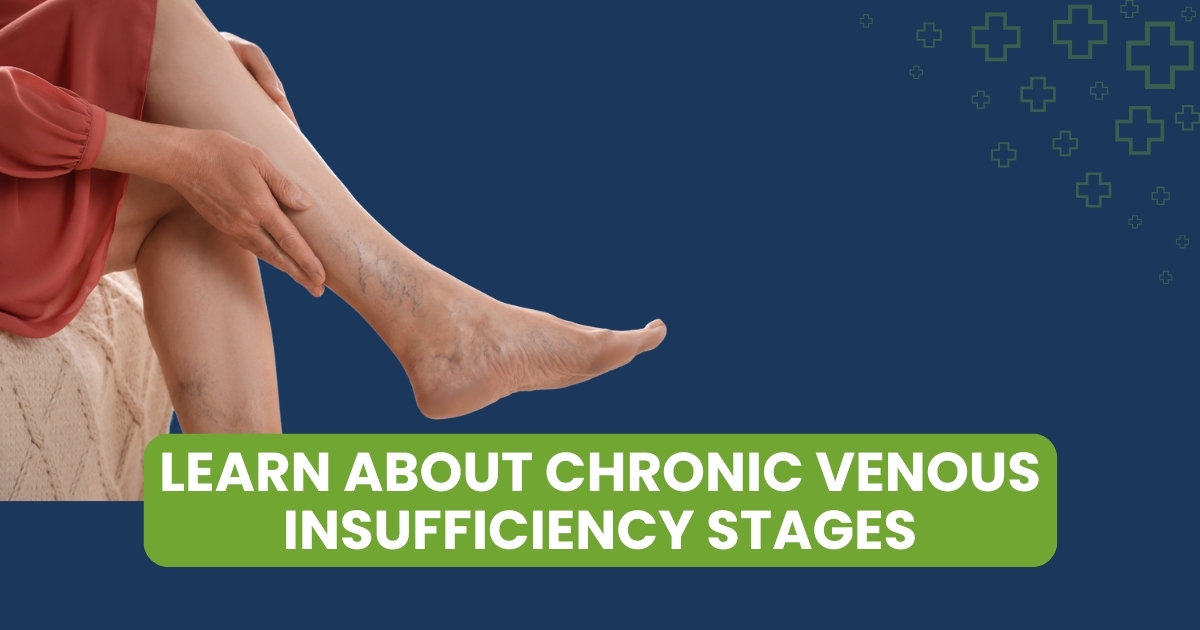 Chronic Venous Insufficiency Stages & Treatment Guide