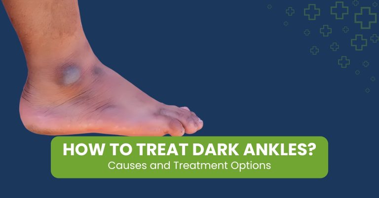 How to Treat Dark Ankles: Causes and Treatment Options