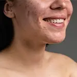 Skin Conditions
