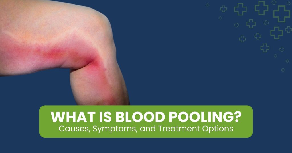 Blood Pooling in Legs — Causes and Treatments