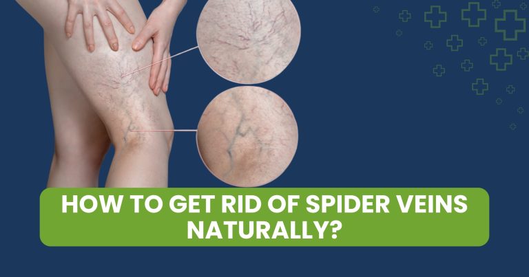 How to Get Rid of Spider Veins Naturally